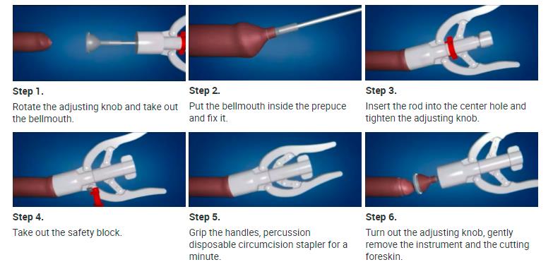 disposable circumcision stapler use